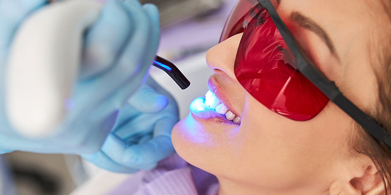 Teeth Whitening in Cape Coral FL